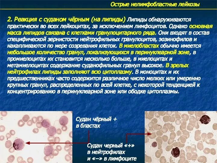 Острые нелимфобластные лейкозы 2. Реакция с суданом чёрным (на липиды) Липиды обнаруживаются