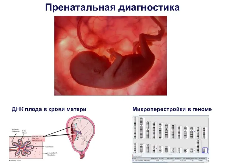 Зачем проводить ПГС? Пренатальная диагностика ДНК плода в крови матери Микроперестройки в геноме