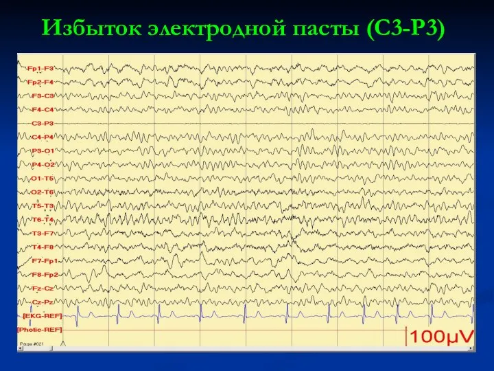 Избыток электродной пасты (С3-Р3)