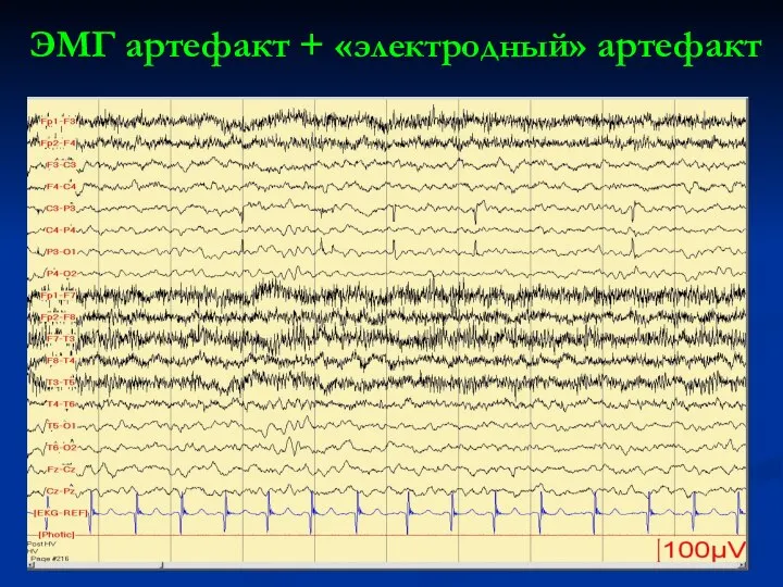 ЭМГ артефакт + «электродный» артефакт