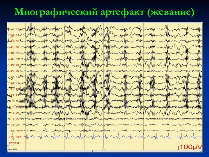 Миографический артефакт (жевание)