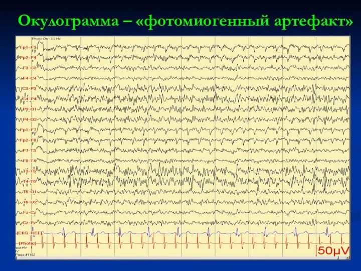 Окулограмма – «фотомиогенный артефакт»