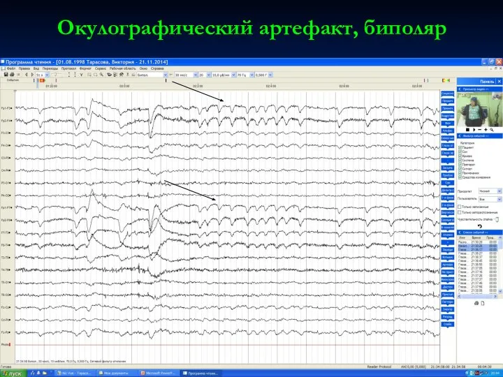 Окулографический артефакт, биполяр