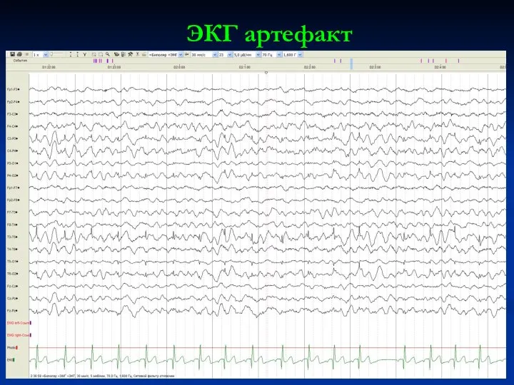 ЭКГ артефакт