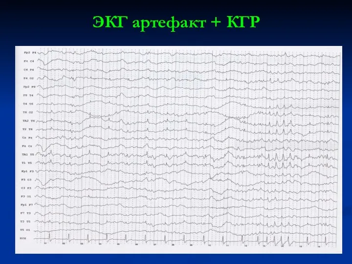ЭКГ артефакт + КГР