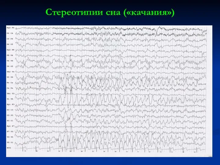 Стереотипии сна («качания»)