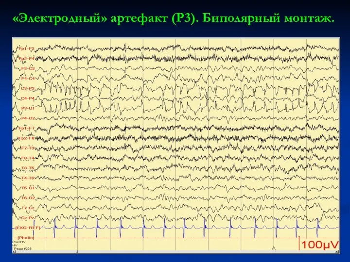 «Электродный» артефакт (Р3). Биполярный монтаж.