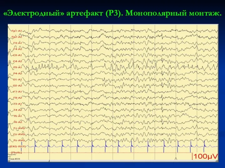 «Электродный» артефакт (Р3). Монополярный монтаж.