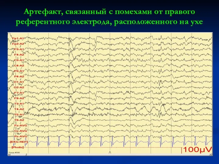 Артефакт, связанный с помехами от правого референтного электрода, расположенного на ухе