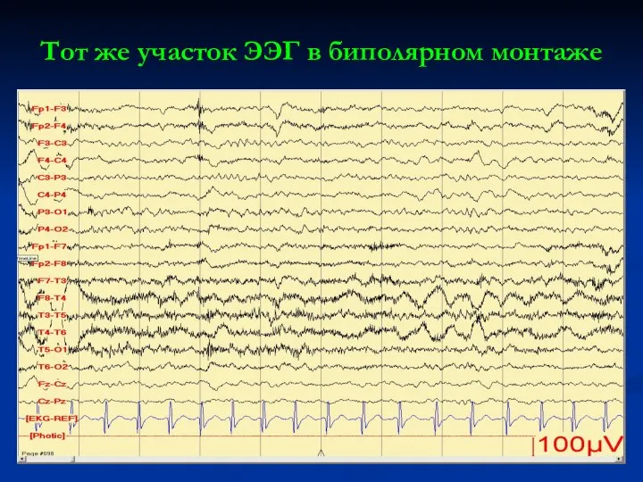 Тот же участок ЭЭГ в биполярном монтаже