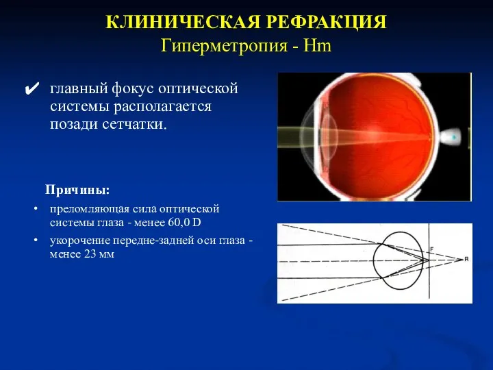 КЛИНИЧЕСКАЯ РЕФРАКЦИЯ Гиперметропия - Hm главный фокус оптической системы располагается позади сетчатки.