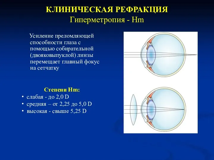 КЛИНИЧЕСКАЯ РЕФРАКЦИЯ Гиперметропия - Hm Cтепени Hm: слабая - до 2,0 D