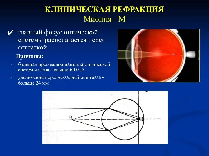 КЛИНИЧЕСКАЯ РЕФРАКЦИЯ Миопия - М главный фокус оптической системы располагается перед сетчаткой.