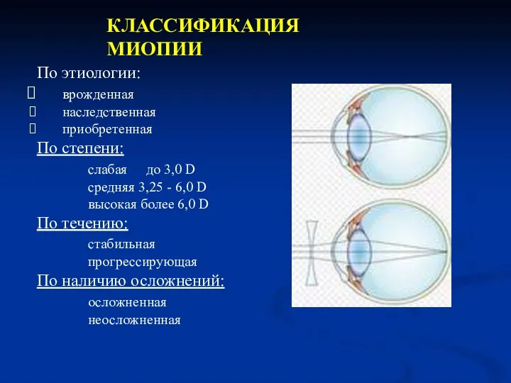 КЛАССИФИКАЦИЯ МИОПИИ По этиологии: врожденная наследственная приобретенная По степени: слабая до 3,0