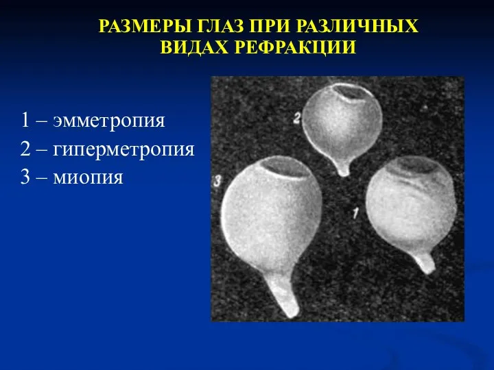 РАЗМЕРЫ ГЛАЗ ПРИ РАЗЛИЧНЫХ ВИДАХ РЕФРАКЦИИ 1 – эмметропия 2 – гиперметропия 3 – миопия