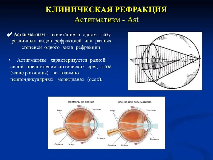 КЛИНИЧЕСКАЯ РЕФРАКЦИЯ Астигматизм - Ast Астигматизм - сочетание в одном глазу различных