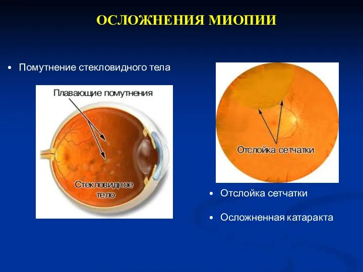 ОСЛОЖНЕНИЯ МИОПИИ Отслойка сетчатки Осложненная катаракта Помутнение стекловидного тела