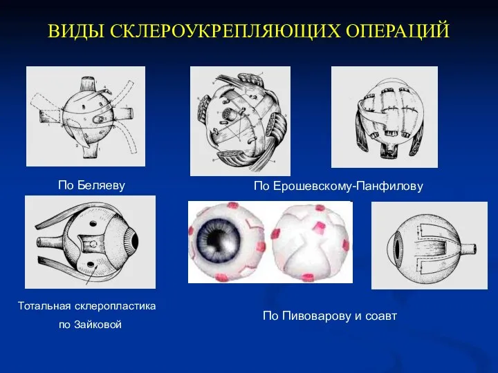 ВИДЫ СКЛЕРОУКРЕПЛЯЮЩИХ ОПЕРАЦИЙ По Беляеву По Ерошевскому-Панфилову Тотальная склеропластика по Зайковой По Пивоварову и соавт