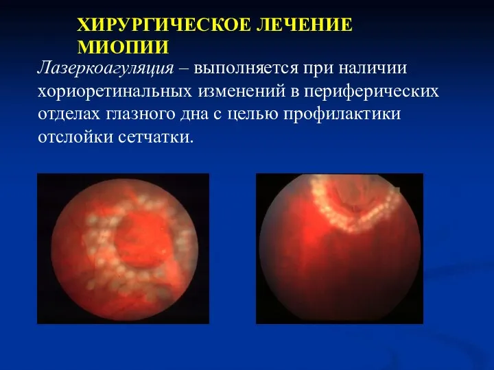 Лазеркоагуляция – выполняется при наличии хориоретинальных изменений в периферических отделах глазного дна