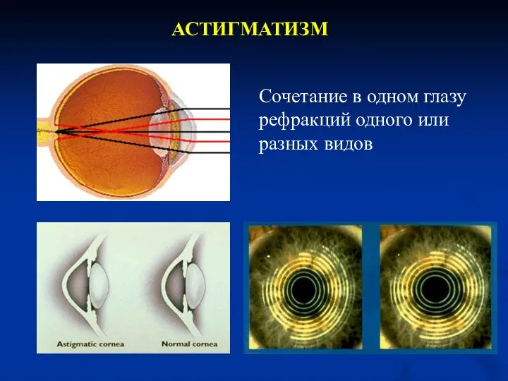 АСТИГМАТИЗМ Сочетание в одном глазу рефракций одного или разных видов