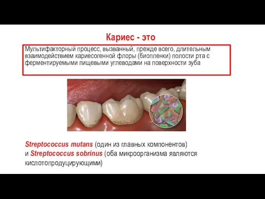 Мультифакторный процесс, вызванный, прежде всего, длительным взаимодействием кариесогенной флоры (биопленки) полости рта