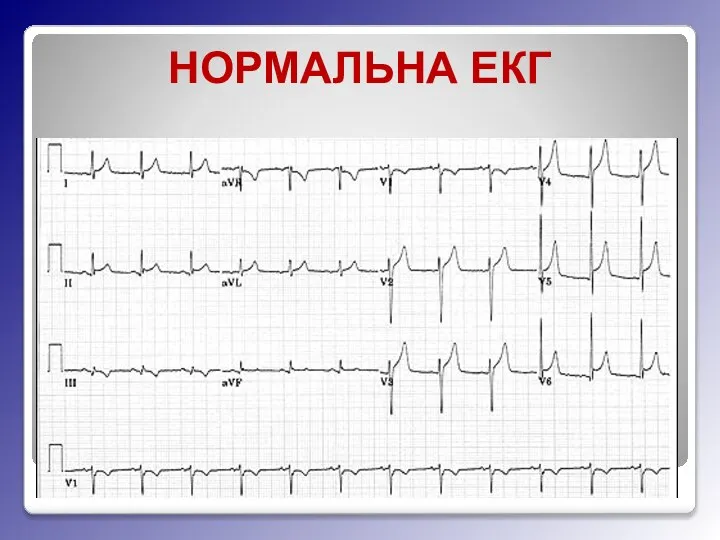 НОРМАЛЬНА ЕКГ