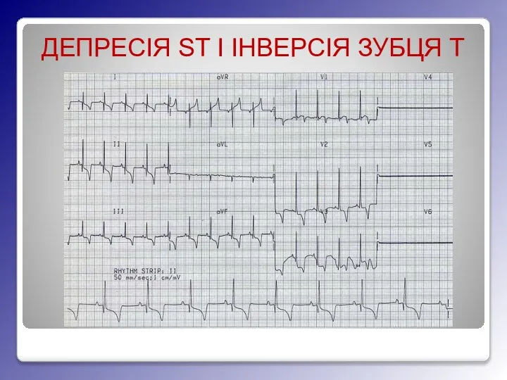 ДЕПРЕСІЯ ST І ІНВЕРСІЯ ЗУБЦЯ T