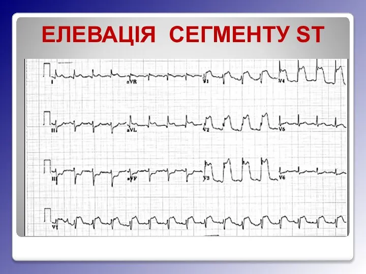 ЕЛЕВАЦІЯ СЕГМЕНТУ ST