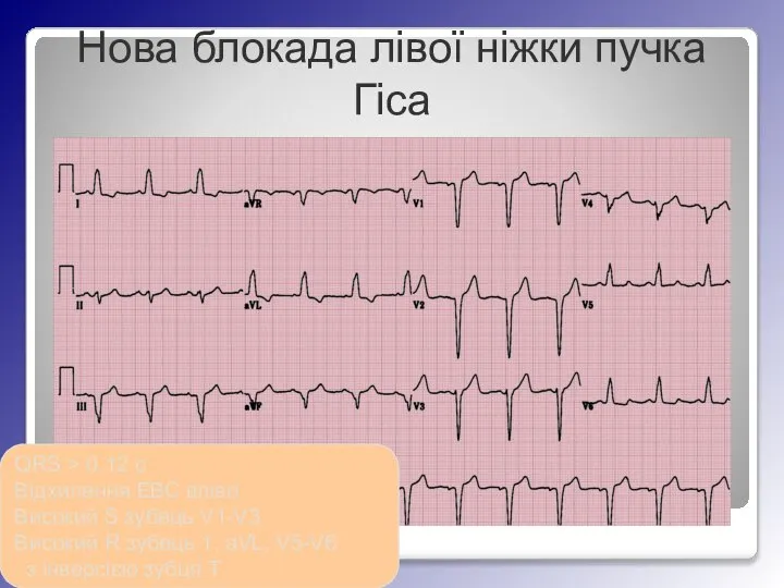 Нова блокада лівої ніжки пучка Гіса QRS > 0.12 с Відхилення ЕВС