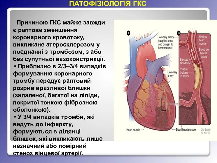 Причиною ГКС майже завжди є раптове зменшення коронарного кровотоку, викликане атеросклерозом у