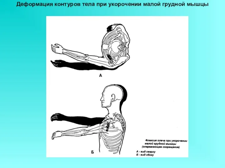 Деформация контуров тела при укорочении малой грудной мышцы