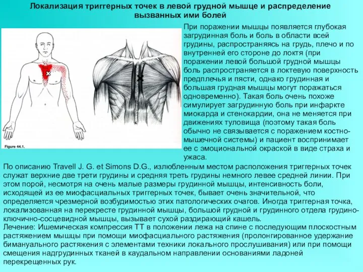 Локализация триггерных точек в левой грудной мышце и распределение вызванных ими болей