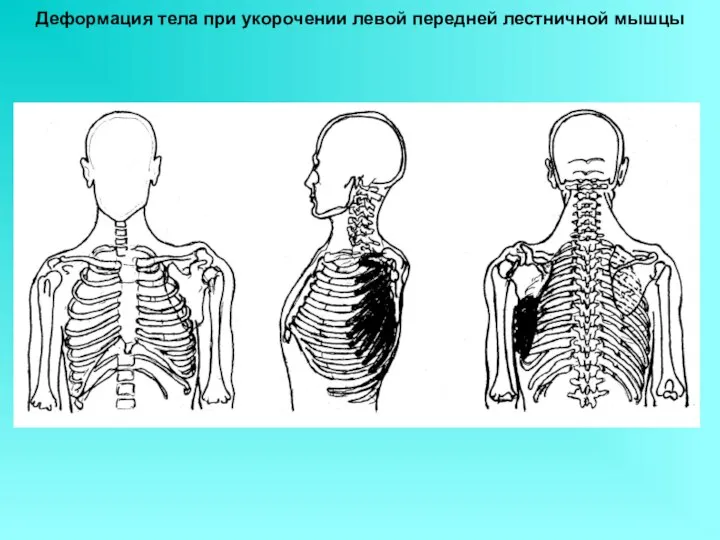 Деформация тела при укорочении левой передней лестничной мышцы