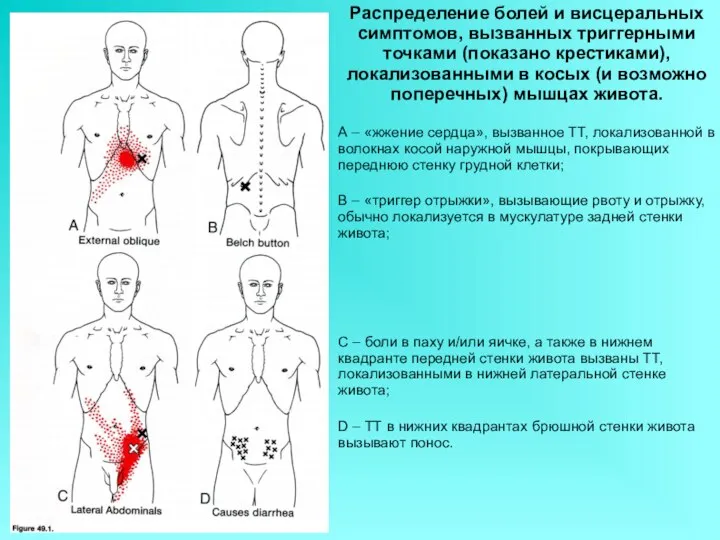 Распределение болей и висцеральных симптомов, вызванных триггерными точками (показано крестиками), локализованными в