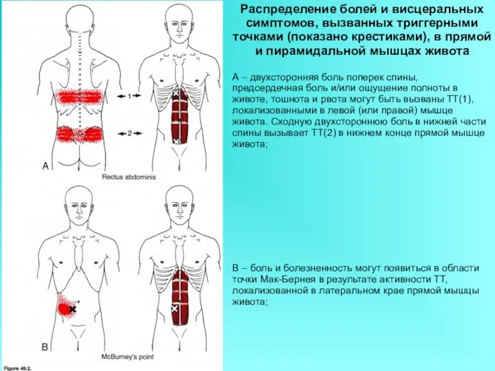 Распределение болей и висцеральных симптомов, вызванных триггерными точками (показано крестиками), в прямой