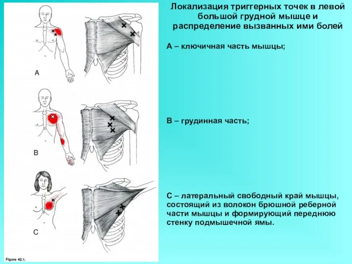 Локализация триггерных точек в левой большой грудной мышце и распределение вызванных ими