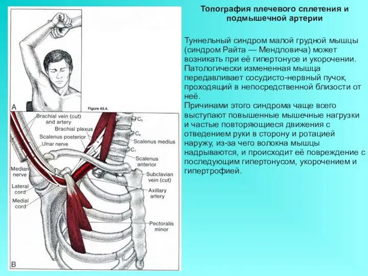 Топография плечевого сплетения и подмышечной артерии Туннельный синдром малой грудной мышцы (синдром