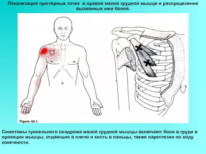 Симптомы туннельного синдрома малой грудной мышцы включают боли в груди в проекции