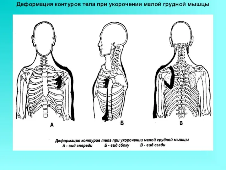 Деформация контуров тела при укорочении малой грудной мышцы