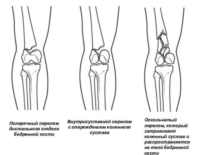 Поперечный перелом дистального отдела бедренной кости Внутрисуставной перелом с повреждением коленного сустава