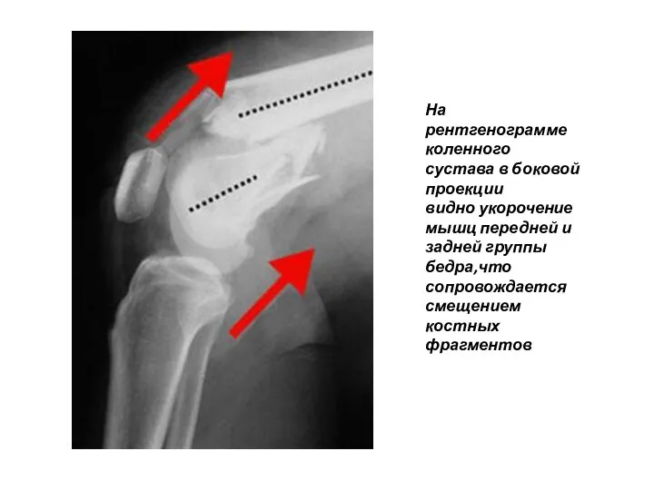 На рентгенограмме коленного сустава в боковой проекции видно укорочение мышц передней и