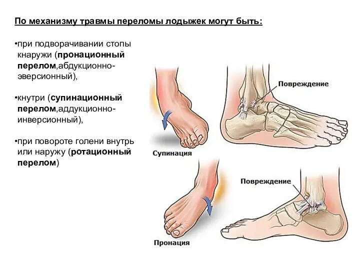 По механизму травмы переломы лодыжек могут быть: при подворачивании стопы кнаружи (пронационный