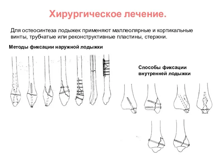 Хирургическое лечение. Для остеосинтеза лодыжек применяют маллеолярные и кортикальные винты, трубчатые или