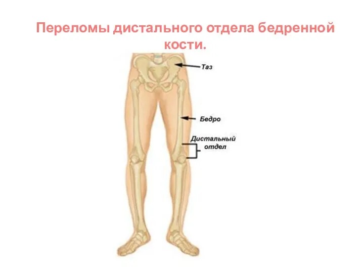 Переломы дистального отдела бедренной кости.