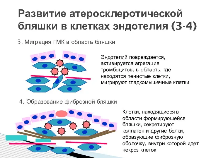 Развитие атеросклеротической бляшки в клетках эндотелия (3-4) 3. Миграция ГМК в область