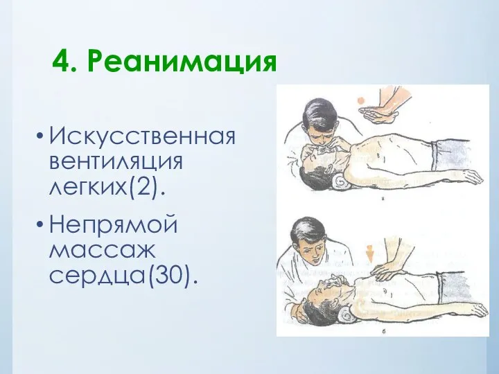 4. Реанимация Искусственная вентиляция легких(2). Непрямой массаж сердца(30).
