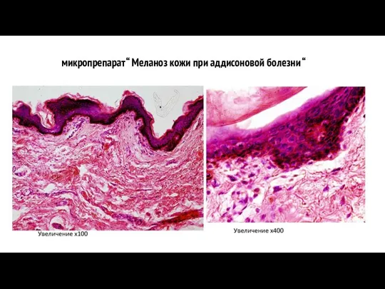 микропрепарат “ Меланоз кожи при аддисоновой болезни “