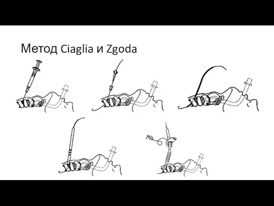 Метод Ciaglia и Zgoda