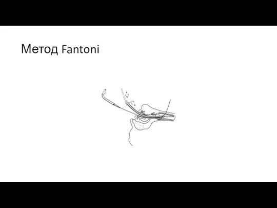 Метод Fantoni