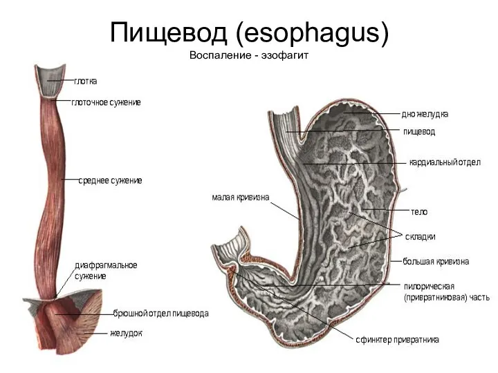 Пищевод (esophagus) Воспаление - эзофагит